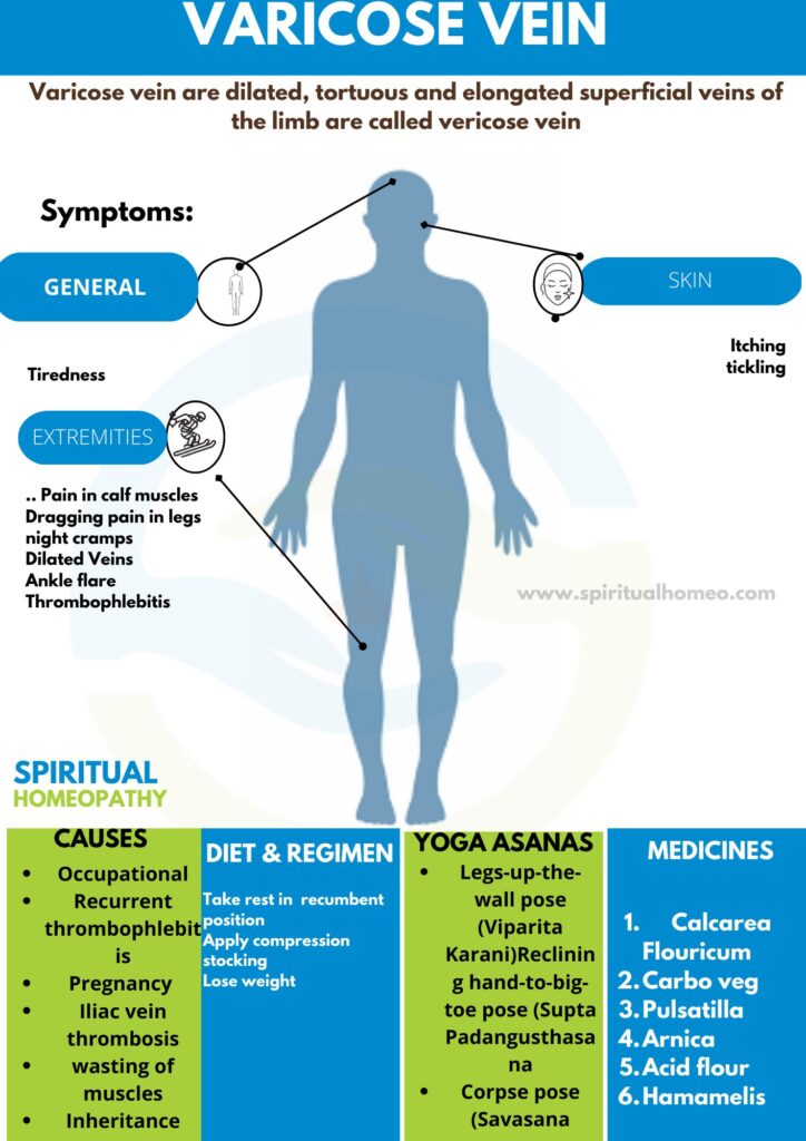 Best Homeopathic Treatment for Varicose Veins