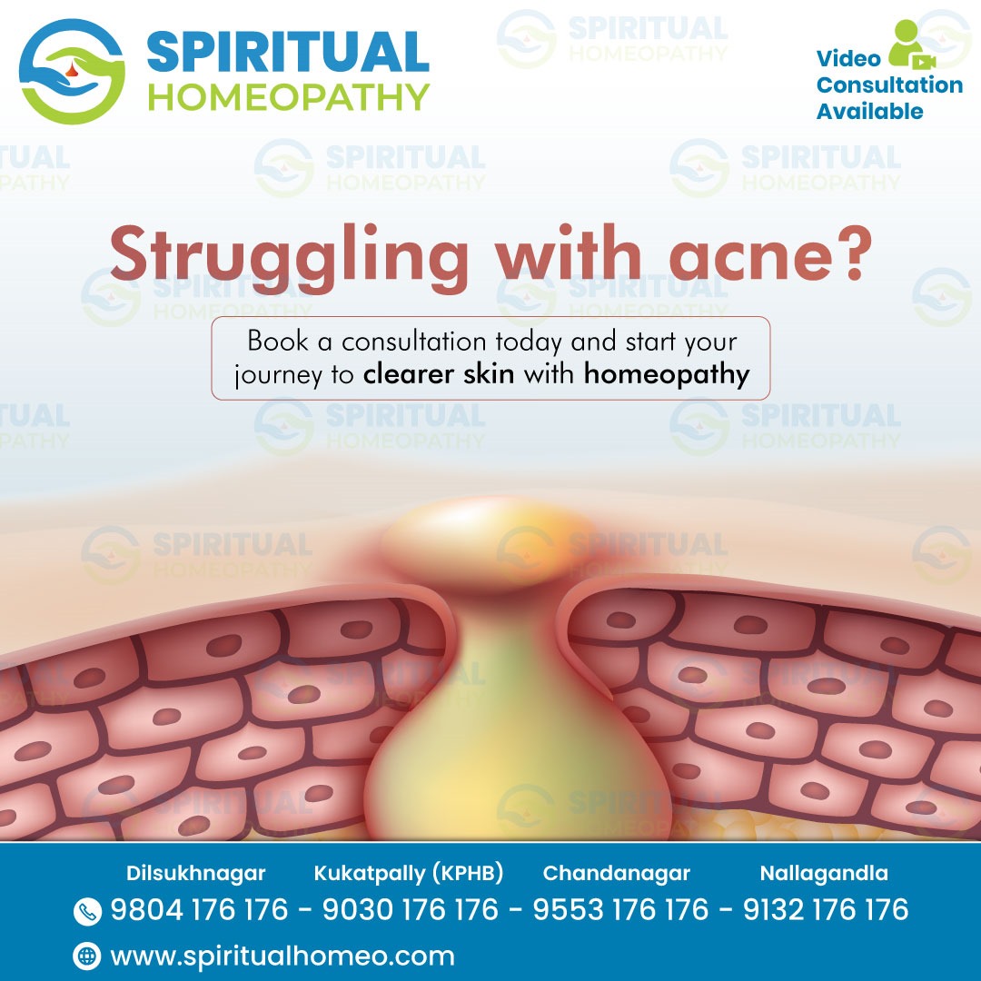 Struggling with Acne? Consult the Best Homeopathy Doctors in Hyderabad for Natural Relief
