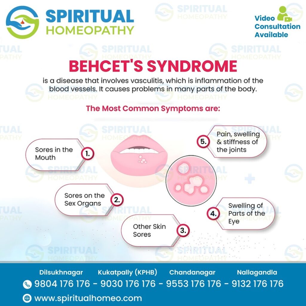 Understanding Behçet’s Syndrome: Symptoms & Treatment Guide