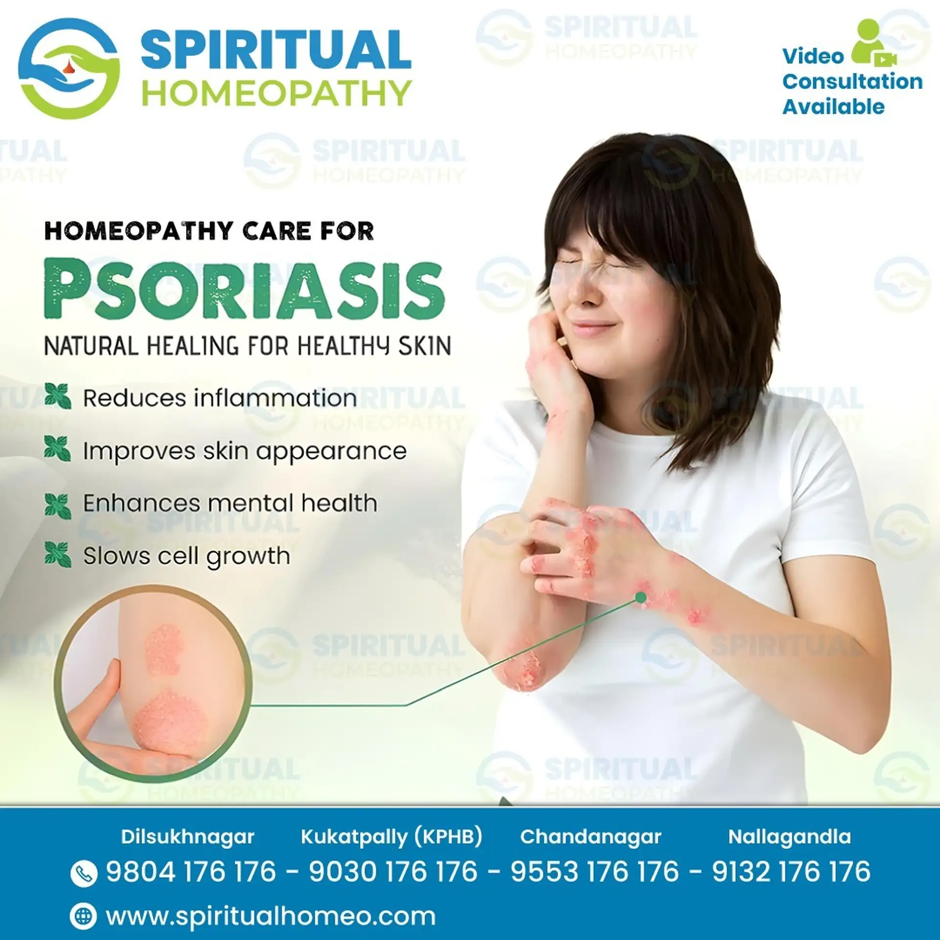 psoriasis