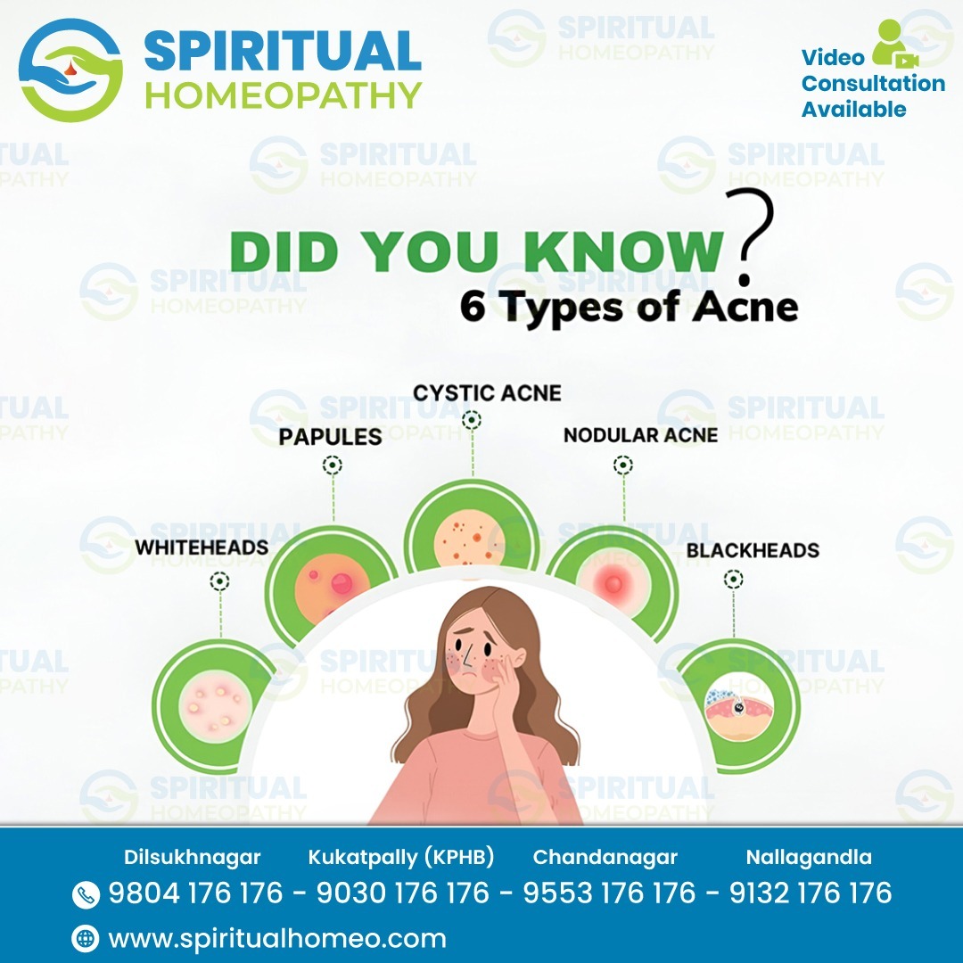 6 Types of Acne: Causes, Symptoms, and Treatment Options