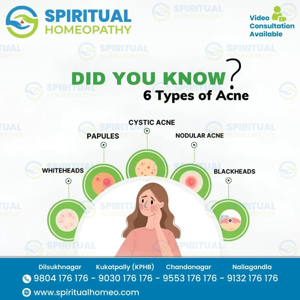 Types of Acne