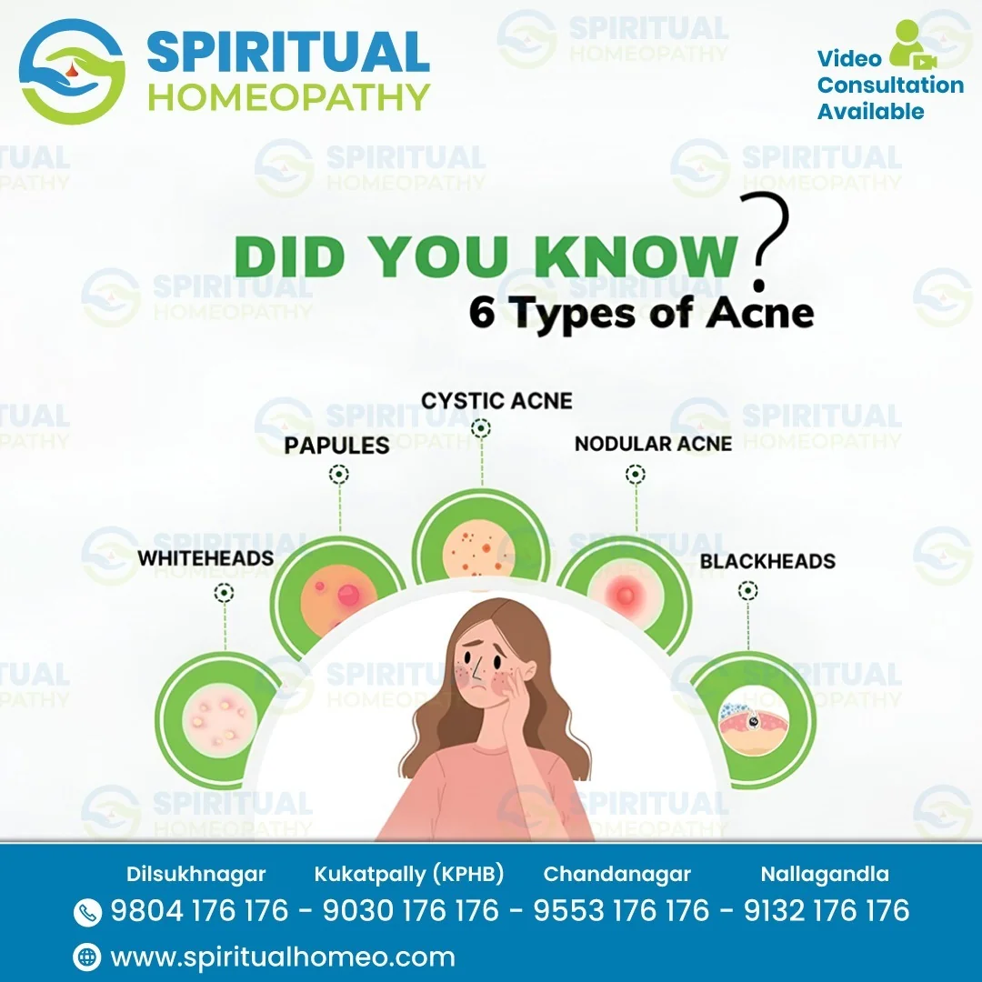 Types of Acne