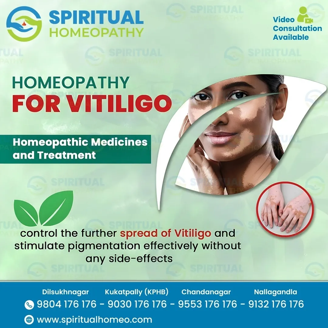 Vitiligo
