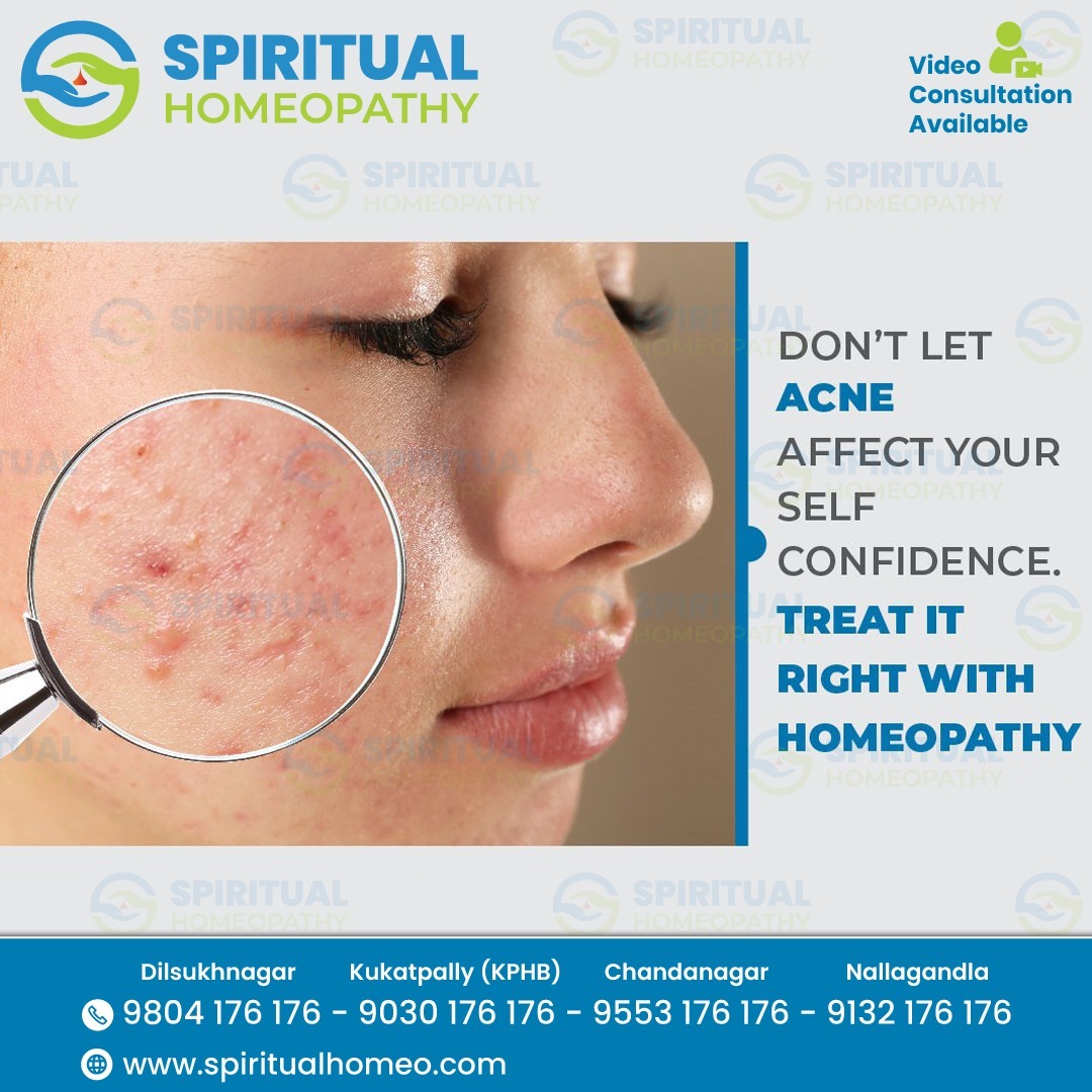 Effective Acne Treatment Tips for Clear and Healthy Skin