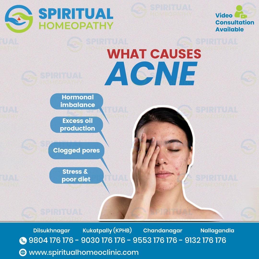 Holistic Homeopathy Treatment for Acne in Hyderabad