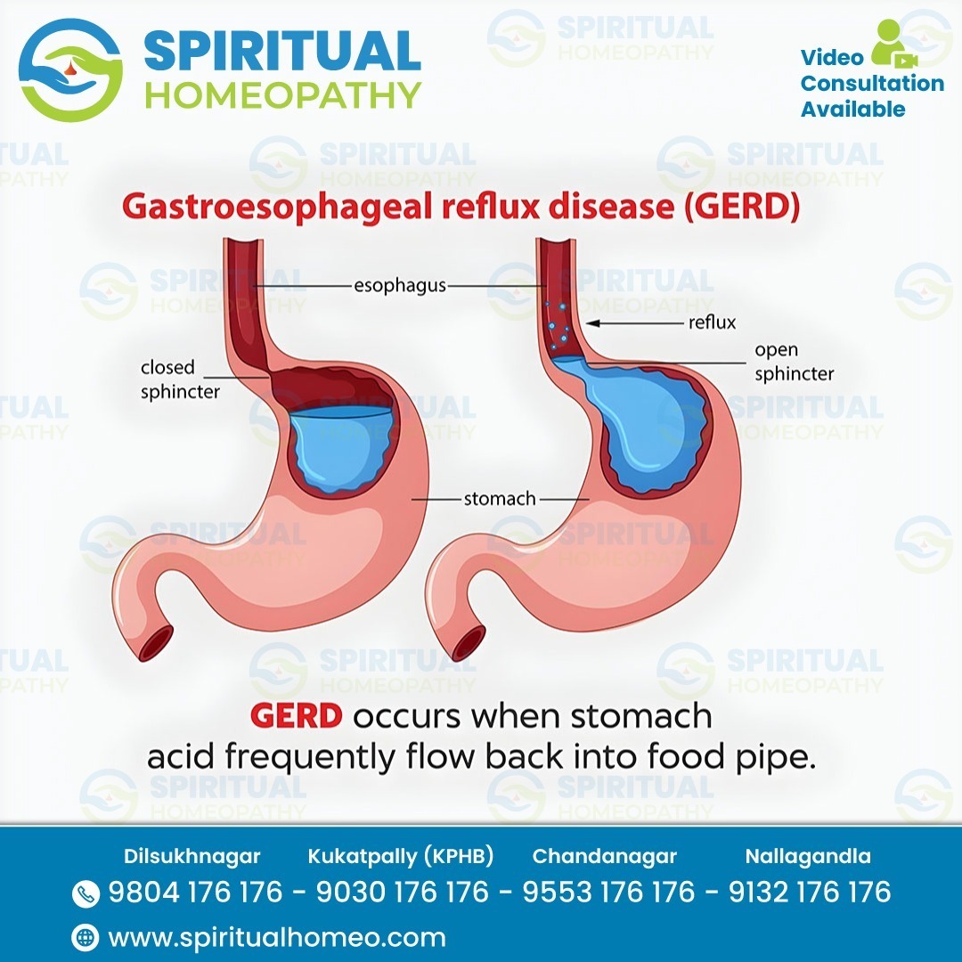 Expert GERD Care at Best Homeopathy Clinic in Chandanagar Hyderabad