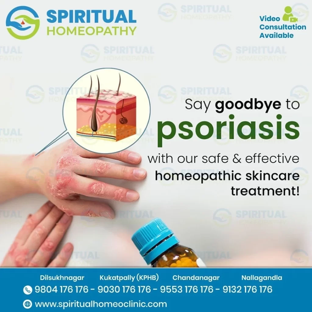psoriasis