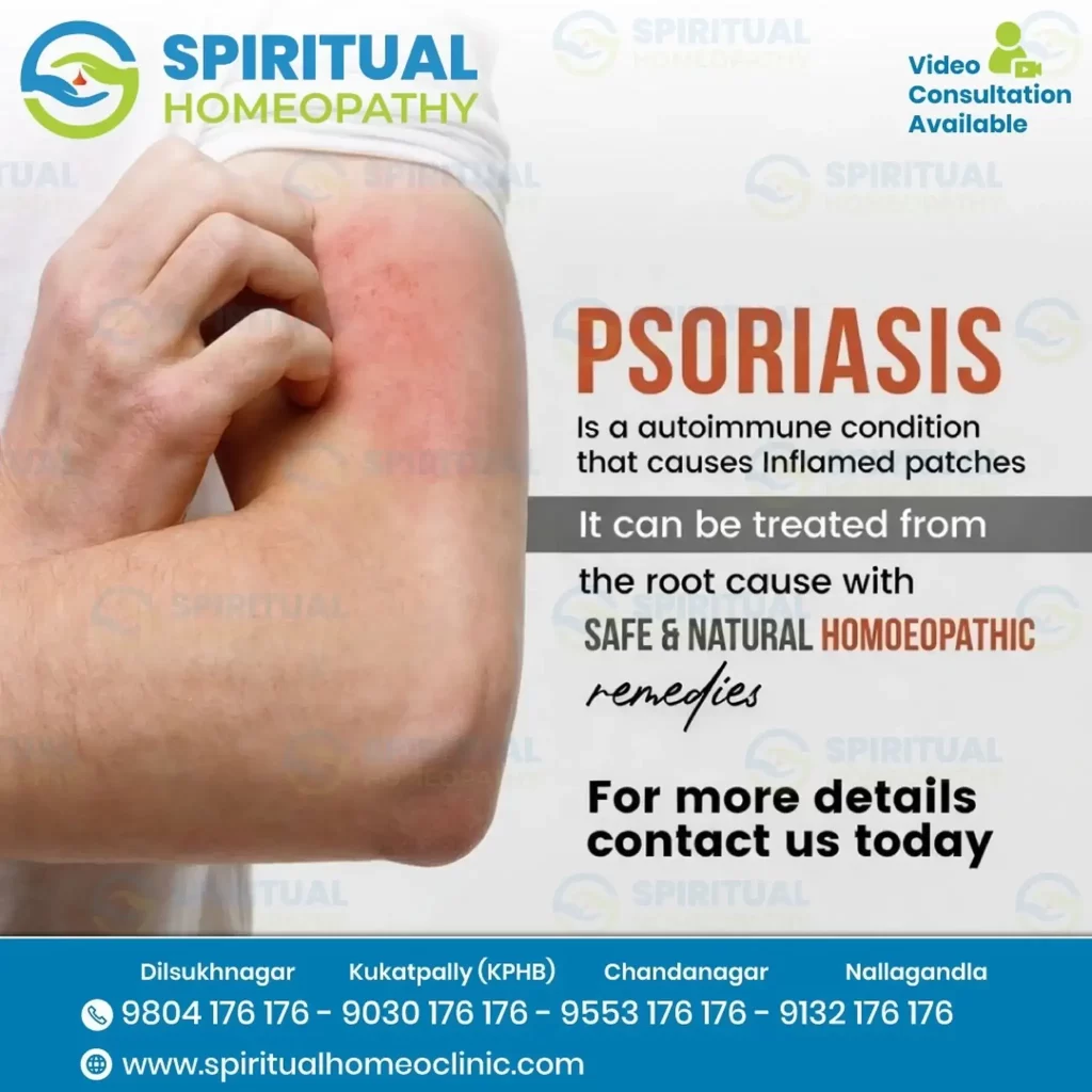 psoriasis