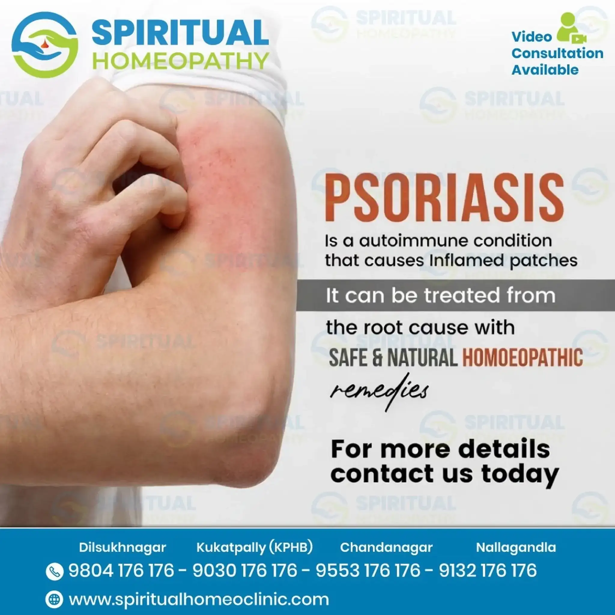 psoriasis