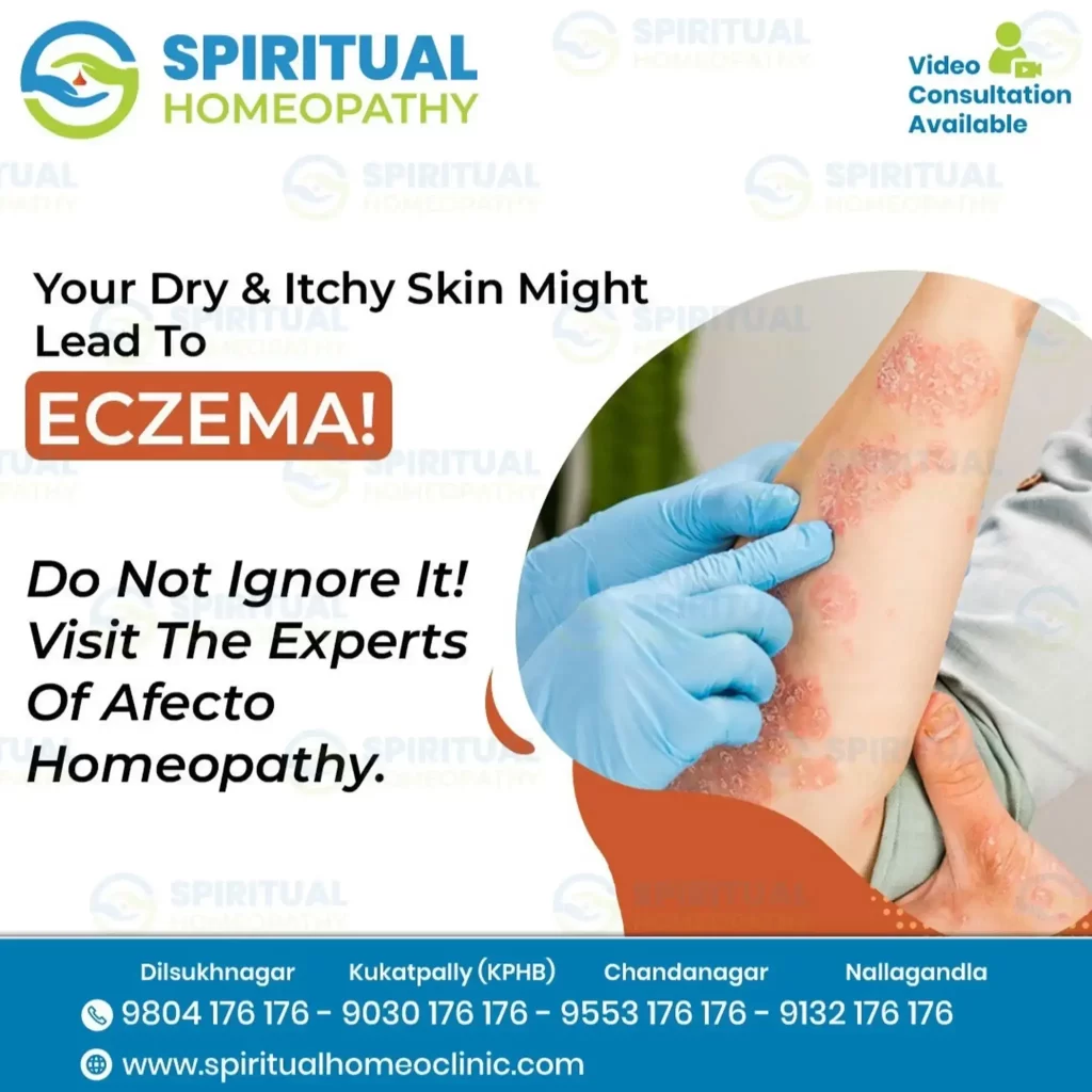 eczema