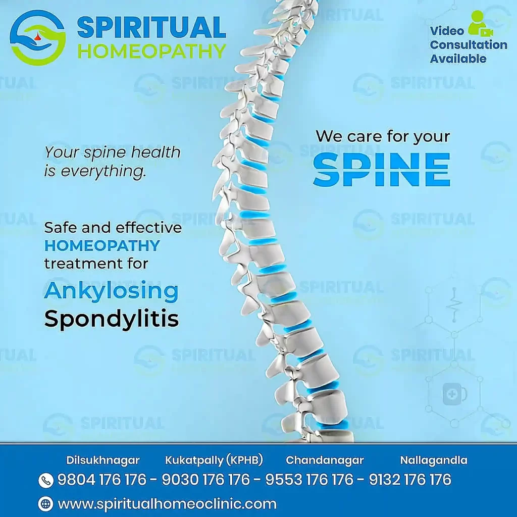 ankylosing spondylitis