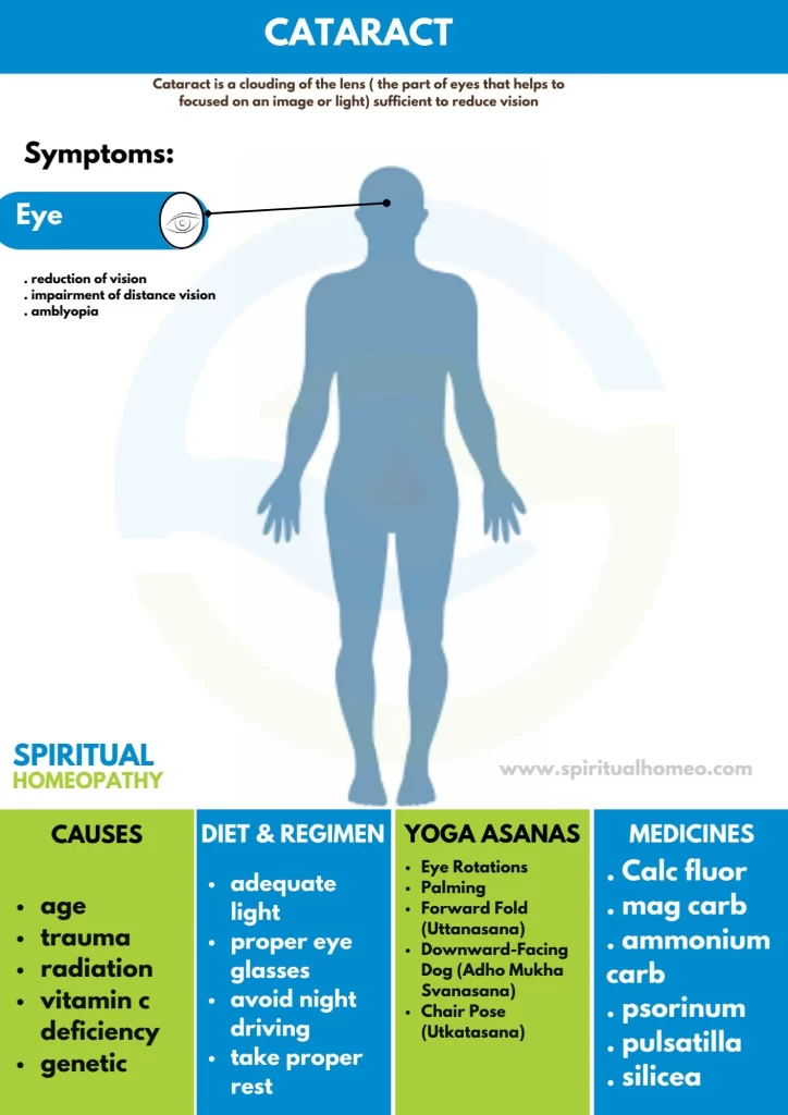 Cataract
